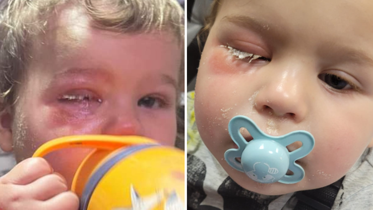 Anglia: Opiekunka w żłobku wlała klej do oka dziecka