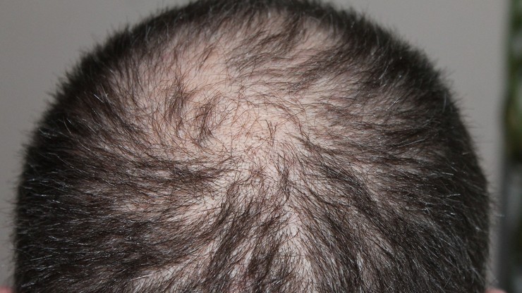 Wśród skutków COVID-19 wypadanie włosów i spadek libido. Badania potwierdzają