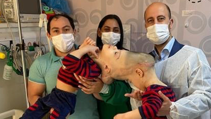 Niezwykła operacja zakończona sukcesem. W Brazylii rozdzielono bliźnięta syjamskie złączone mózgami