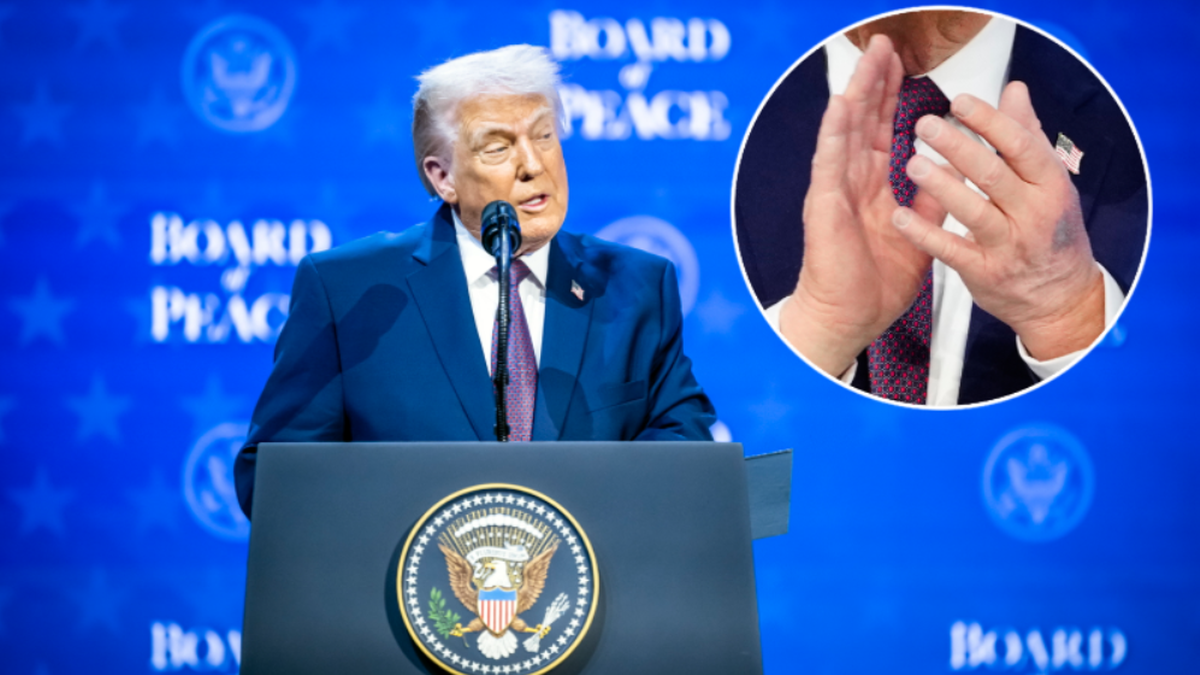 Siniak na dłoni Trumpa przykuł uwagę mediów. Biały Dom wyjaśnia