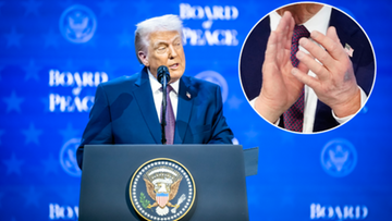Siniak na dłoni Trumpa przykuł uwagę mediów. Biały Dom wyjaśnia