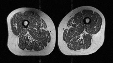 Przekrojowe obrazy rezonansu magnetycznego ud ukazujące tkankę mięśniową i tłuszcz śr&oacute;dmięśniowy.