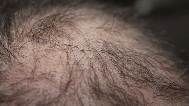 Bliżej leku na łysienie - ogłosili koreańscy naukowcy. Trwają testy na zwierzętach