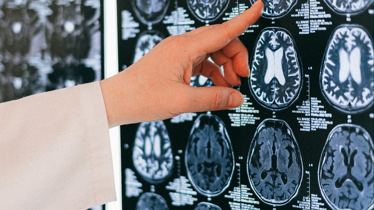 Prof. Włodzimierz Gut: COVID-19 może powodować zmniejszenie mózgu