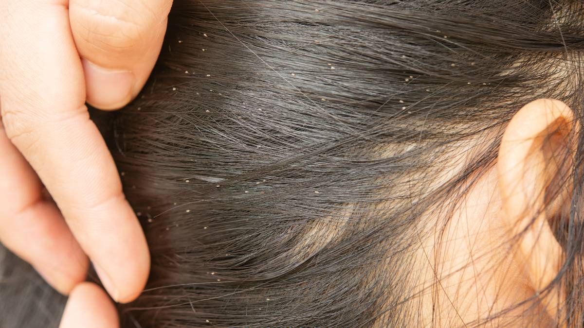W Polsce najczęściej u dzieci występuje wszy, której objawem jest świąd skóry głowy