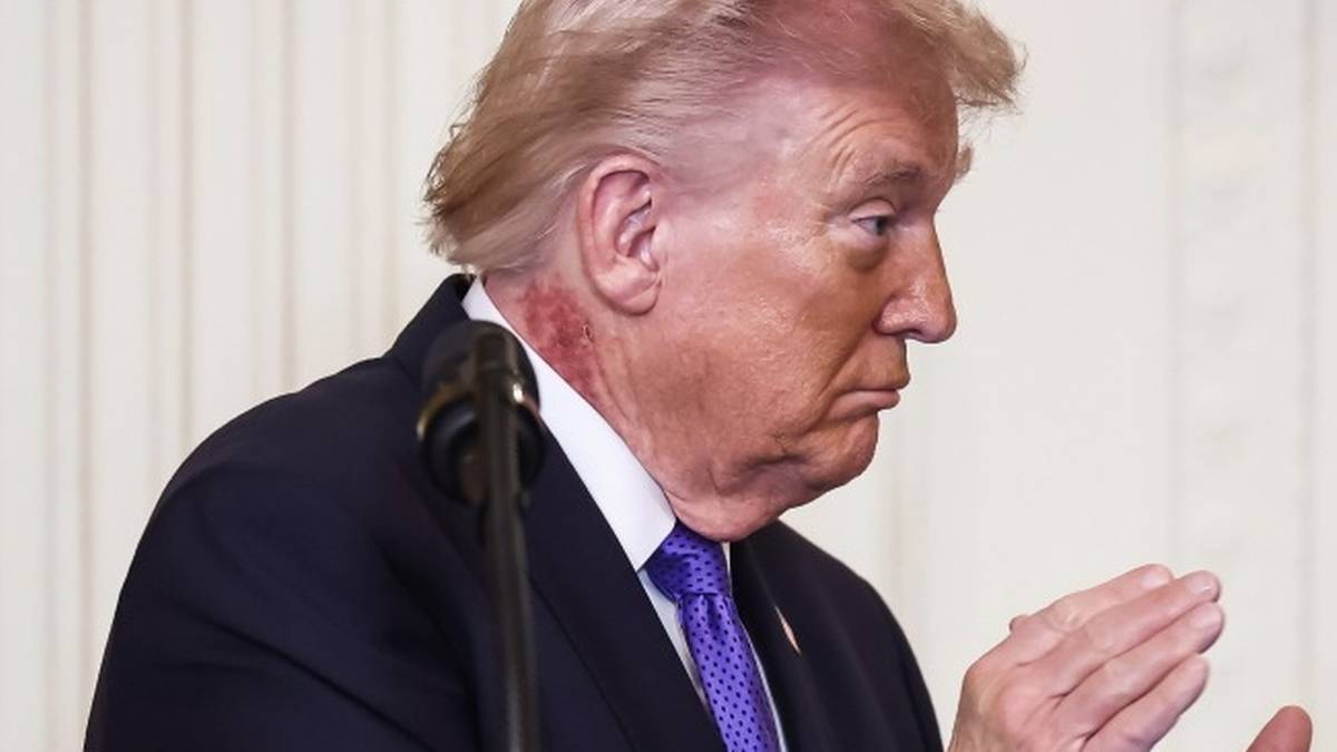 Wysypka na szyi Donalda Trumpa. Lekarz prezydenta wyjaśnia przyczynę