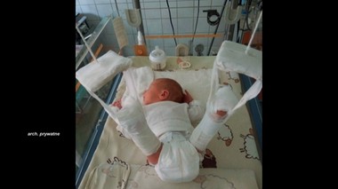 Podczas porodu lekarze złamali dziecku nogę
