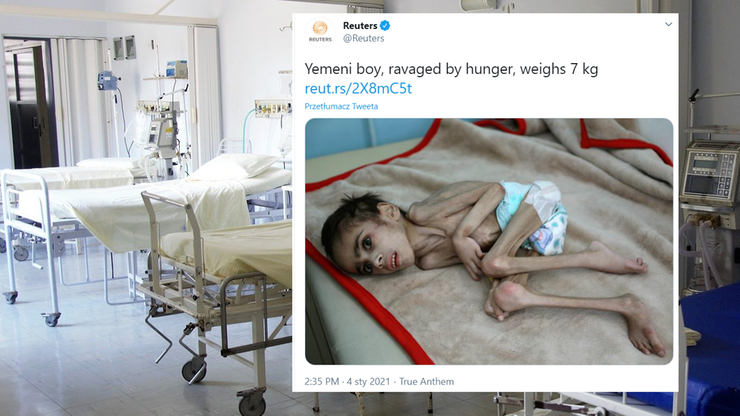 Jemen. Skrajnie wygłodzony 7-latek trafił do szpitala. Waży 7 kilogramów
