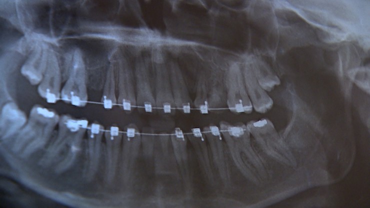 Ortodonta miał wyprostować zęby. Teraz poszkodowani walczą o pieniądze