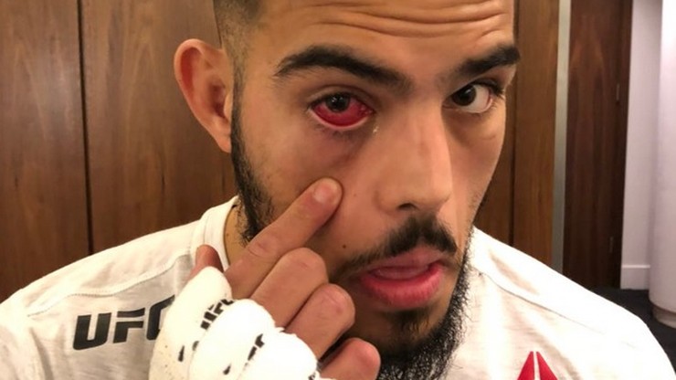 Groźna infekcja oka wykluczyła wojownika z UFC w Londynie (ZDJĘCIA)