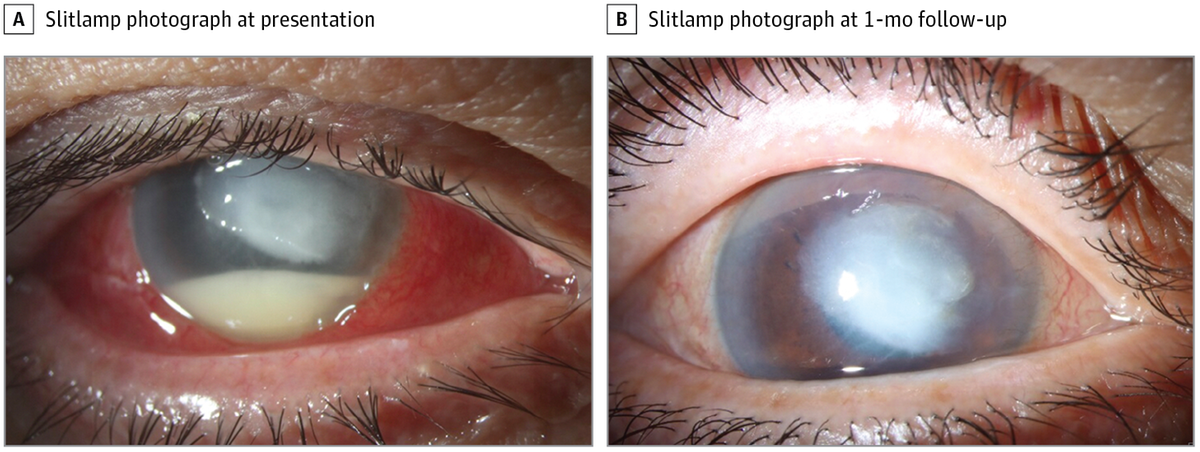Ciężkie zapalenie oka wywołane lekoodpornym szczepem pałeczki ropy błękitnej u 72-letniej pacjentki