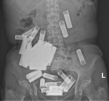 Zdjęcie rentgenowskie znajdujących się w żołądku pacjentki baterii