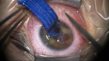 W oko wbił się metalowy element inhalatora. Lubelscy lekarze uratowali wzrok 6-latki