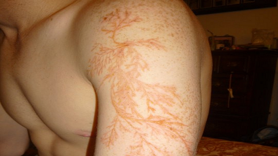Niesamowity "tatuaż" po porażeniu piorunem. Fot. Twitter.