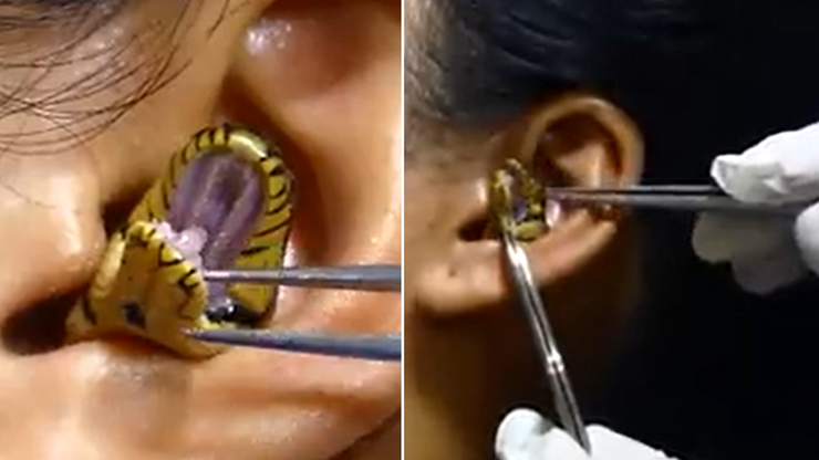 Indie: Nagranie, na którym wąż utknął w uchu kobiety