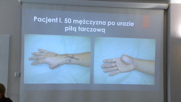 Wrocław: udana implantacja palca od nogi w miejsce kciuka