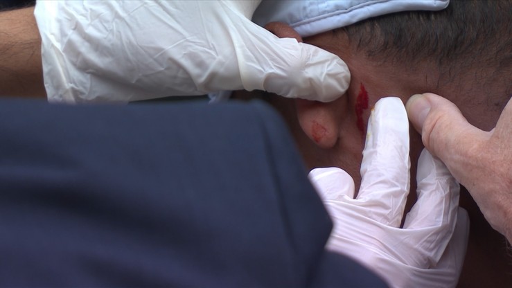 Wimbledon: Rozcięcie koło ucha! Potężne uderzenie zwaliło zawodnika z nóg (WIDEO)