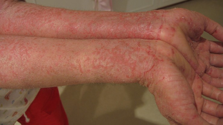 Atopowe zapalenie skóry. Restrykcje pandemiczne nasiliły objawy u nastolatków