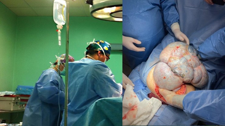 Kędzierzyn-Koźle: Lekarze wycięli pacjentce 11-kilogramowego guza jajnika. Mógł rosnąć kilka lat