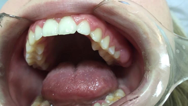 Zła higiena jamy ustnej może zaostrzać przebieg COVID-19