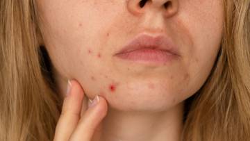 Zbliżenie na fragment twarzy kobiety z niedoskonałościami sk&oacute;rnymi, takimi jak pryszcze i zaczerwienienia.