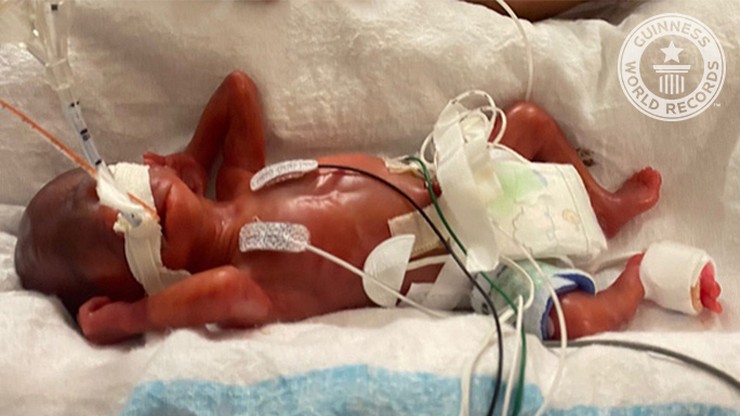 USA. Najmłodszy wcześniak świata. Chłopiec z Alabamy urodził się w 21. tygodniu ciąży