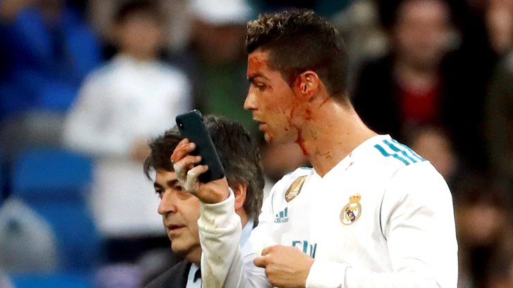 Jak mocno krwawił Ronaldo? Gwiazdor sprawdził... na telefonie! (WIDEO)