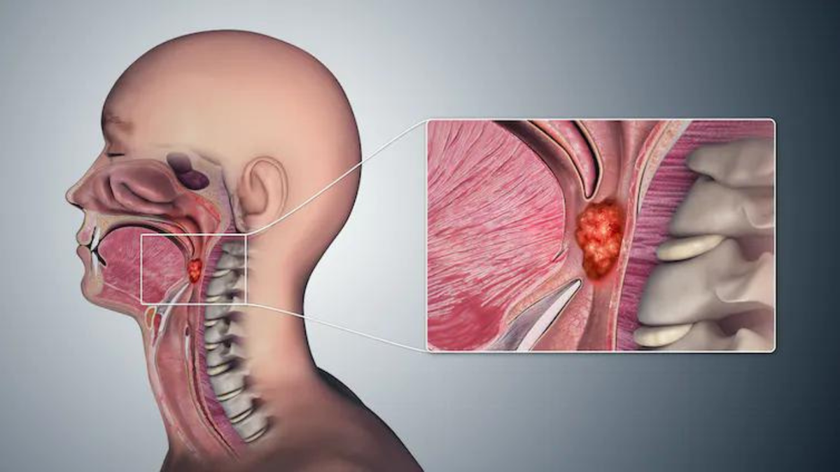 Według CDC za około 70 procent przypadków raka jamy ustnej i gardła odpowiada wirus HPV