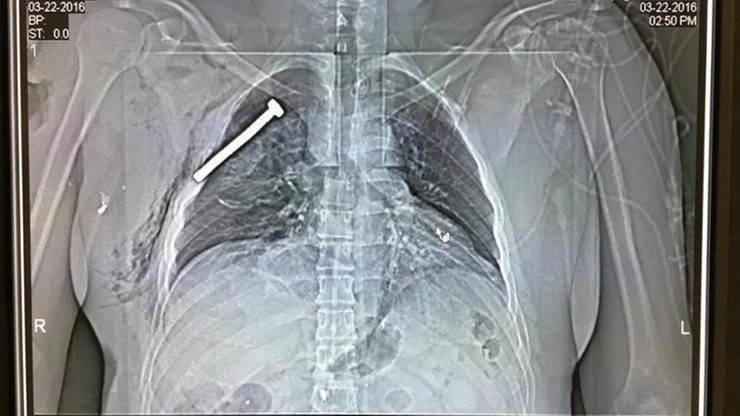 Szpital pokazał zdjęcie rentgenowskie jednego z rannych. Przeżył zamach w Brukseli